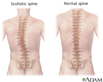 scoliosis