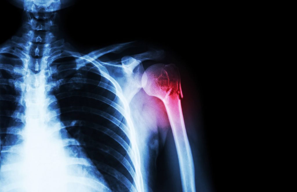 a vállízület röntgen képe az ízületek fájdalom az erőfeszítés után