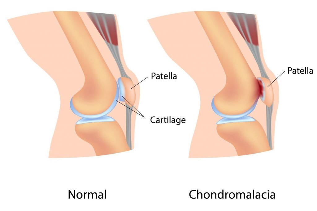 térdízületi fájdalom kezdődött fájdalom a lábban a csípőízület közelében