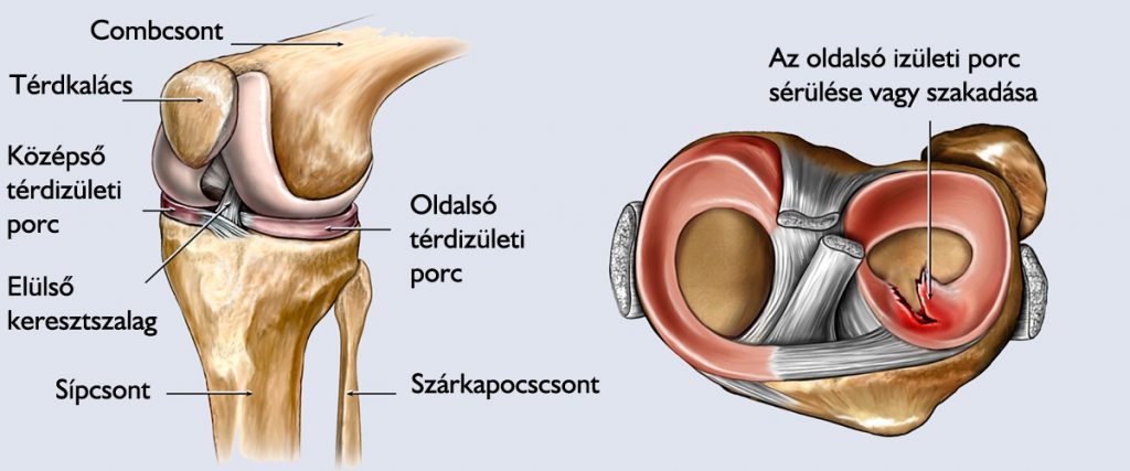 3 fokos térdízület kezelés artrózisa)