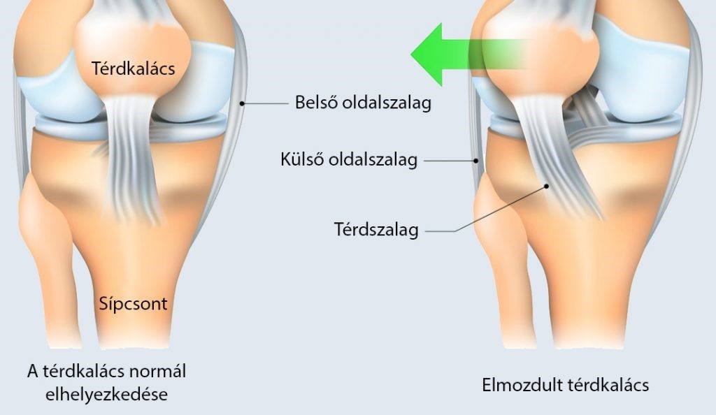 a csípőízület bal artrózisa hogyan kell kezelni a duzzadt ízületeket a lábujjakon