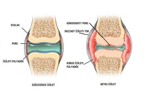 térd izületi szalag sérülés