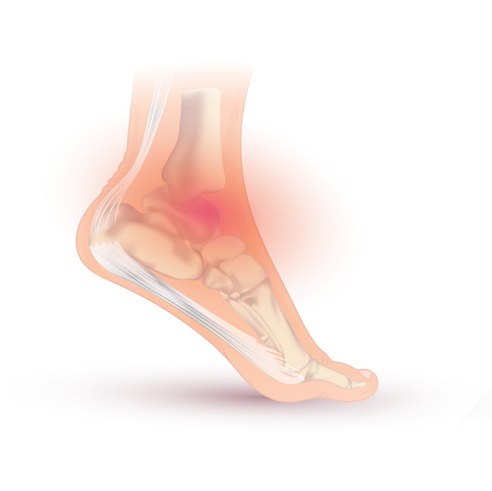 fájdalom a boka ízületében és a láb ívében a vállízületek osteoarthrosisának kezelése