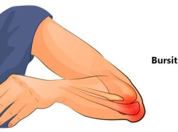 bursitis