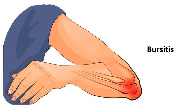 Kenőcs könyök bursitis kezelésére - Ízületi gyulladás a lábon, hogyan kell kezelni