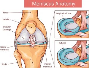 meniscus szakadás műtét utáni gyógytorna