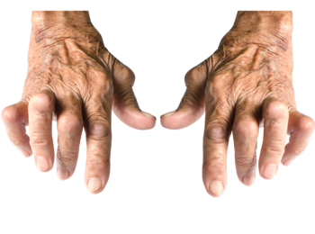 Reumatoid arthritisz – így zajlik a gyógytorna terápia