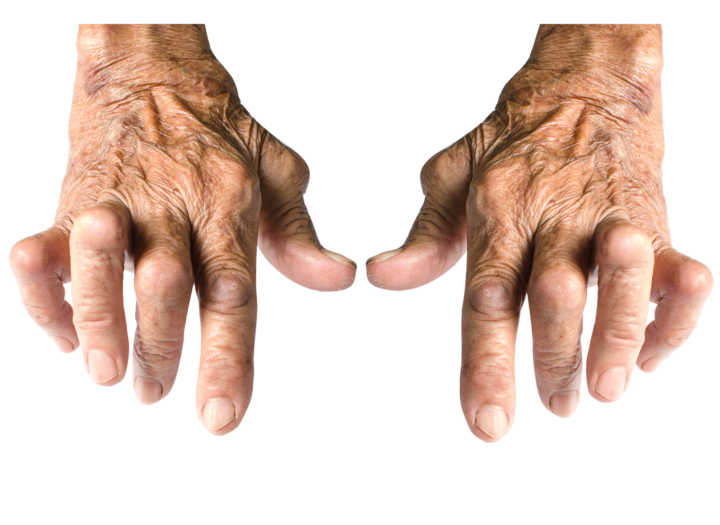Reumatoid arthritisz – így zajlik a gyógytorna terápia