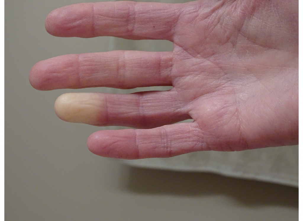 Raynaud-szindróma a kézfejen